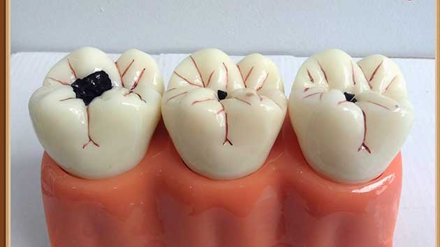 Sâu răng